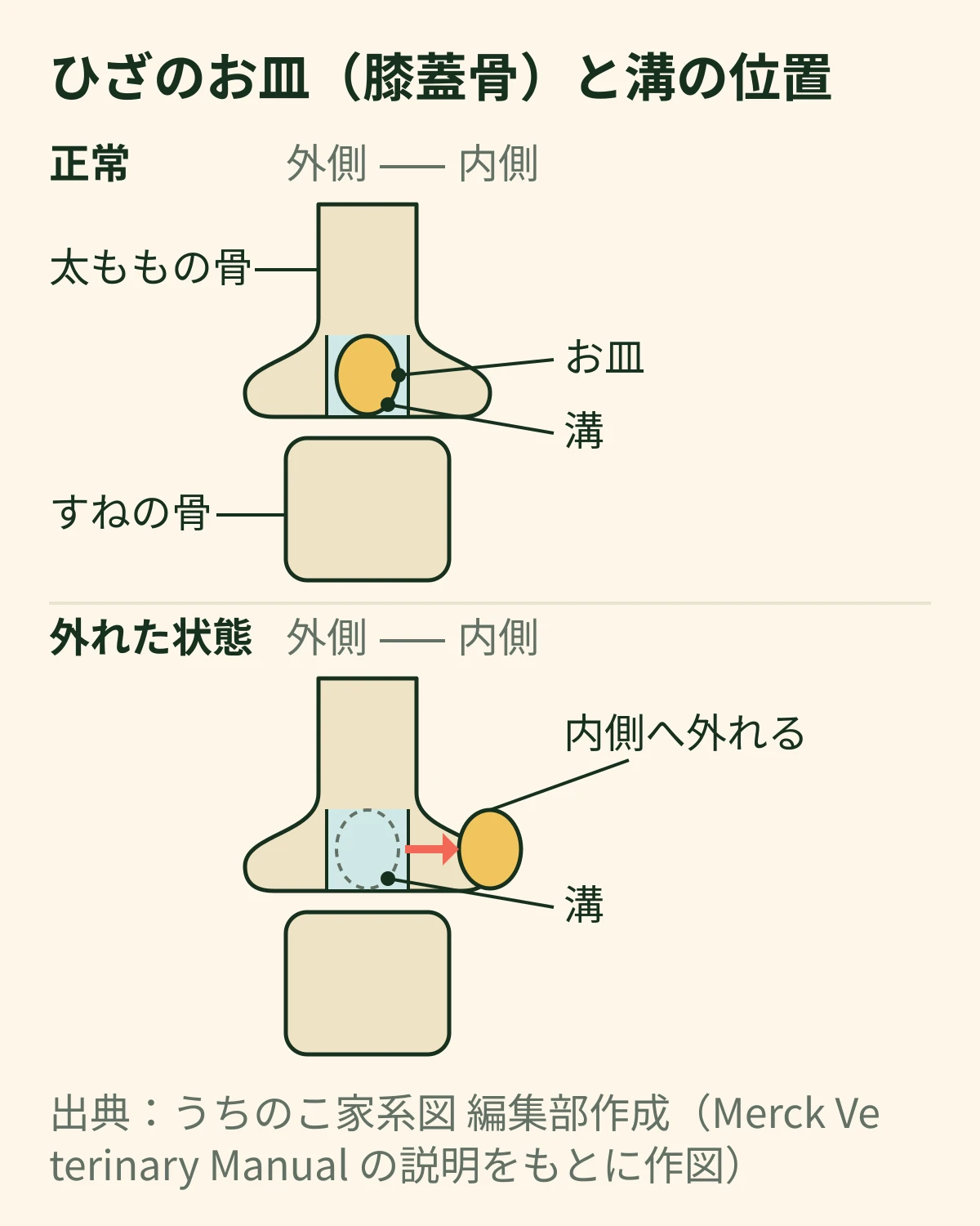 ひざのお皿(膝蓋骨)が太ももの骨の溝に収まった状態と、溝から内側に外れた状態を上下に並べた模式図。溝が浅いとお皿が外れやすいことを示す